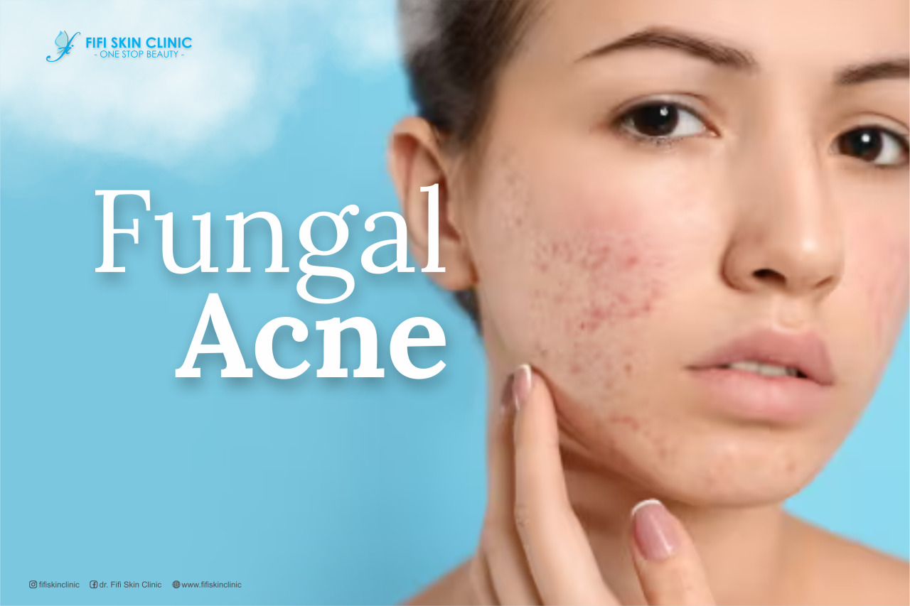 Penyebab dan Cara Mengatasi Fungal Acne