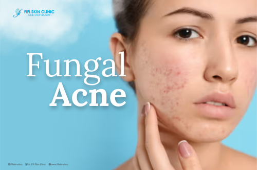 Penyebab dan Cara Mengatasi Fungal Acne